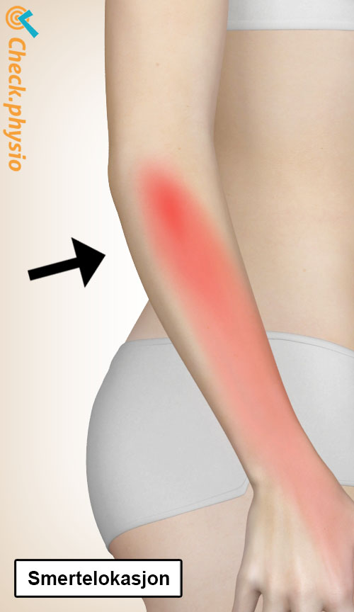 arm radialt tunnelsyndrom lokasjon
