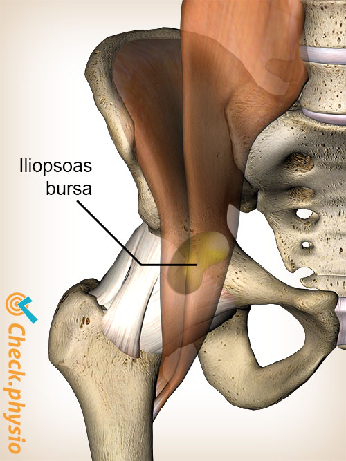 hofte iliopsoas bursa bursitt
