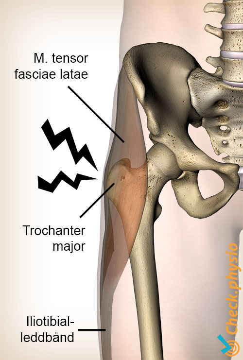 hofte trochanter major smertesyndrom anatomi tensor fasciae latae tractus iliotibialis