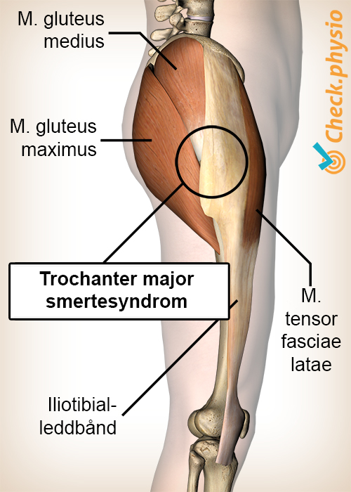 hofte trochanter major smertesyndrom anatomi