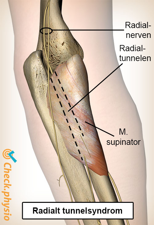 arm radial tunnel nervus radialis