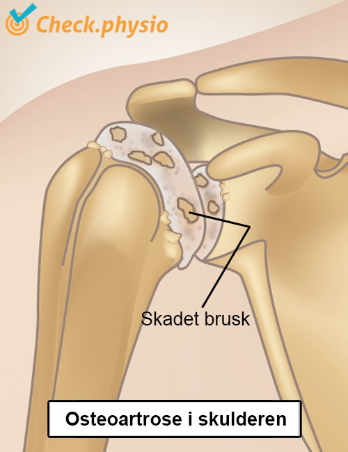 skulder artrose