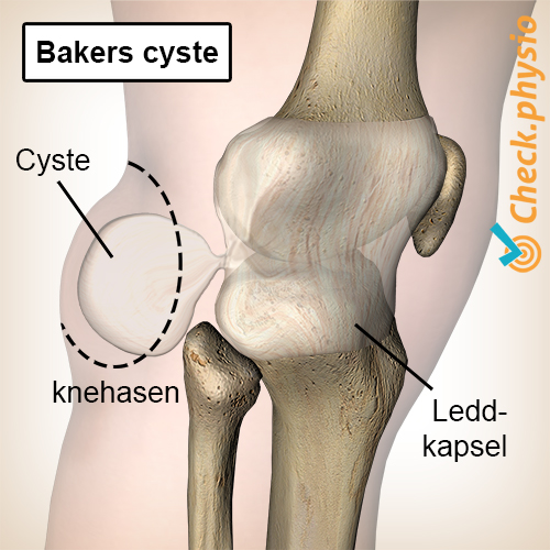 kne bakers cyste popliteal cyste