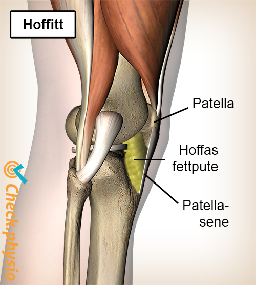 kne Hoffas fettpute hoffitt fettvev