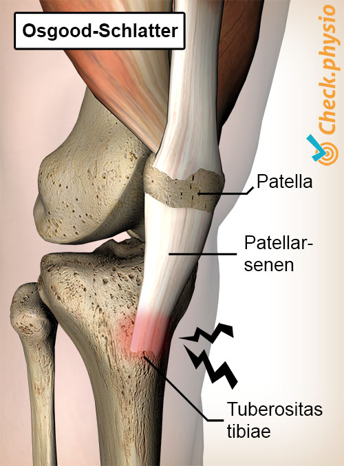kne osgood schlatter smerte patellarsenen