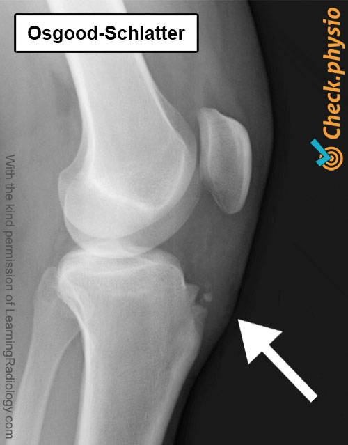 kne osgood schlatter røntgen