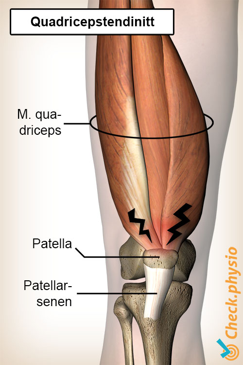 kne quadriceps senebetennelse anatomi