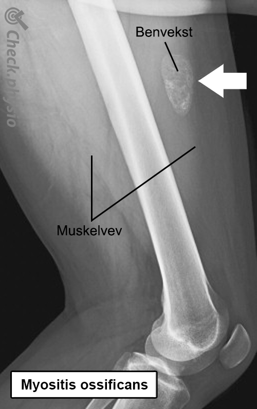 myositis ossificans røntgenbilde anatomi