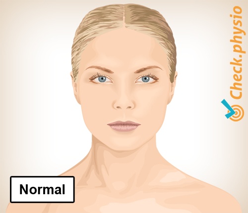 nakke torticollis normal holdning