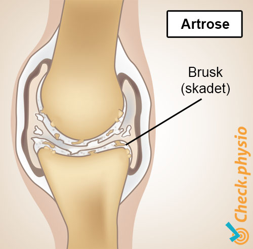 artrose anatomi slitasje