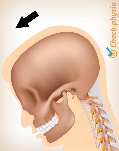 nakke whiplash smerte bevegelse 2