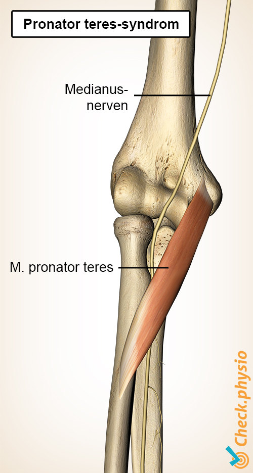 underarm pronator teres muskel medianus nerve syndrom
