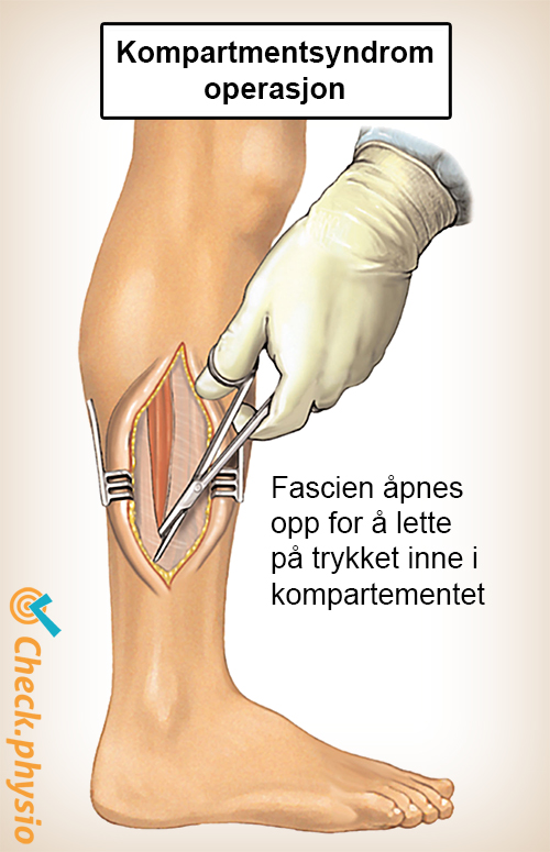 legg kompartmentsyndrom kirurgi