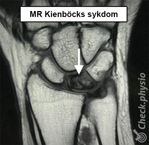 håndledd Kienbocks sykdom MR os lunatum