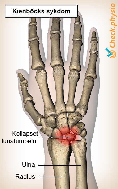 håndledd Kienbocks sykdom os lunatum håndrotsben måneformet ben