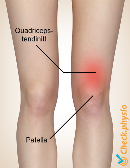 quadriceps senebetennelse