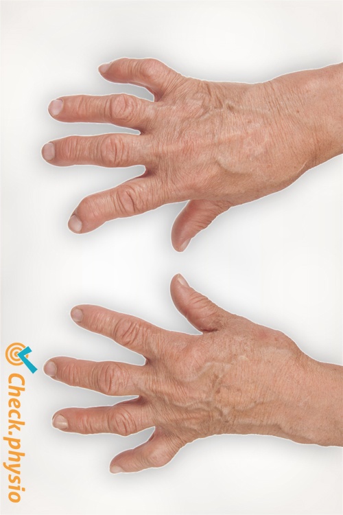 revmatoid artritt fingre
