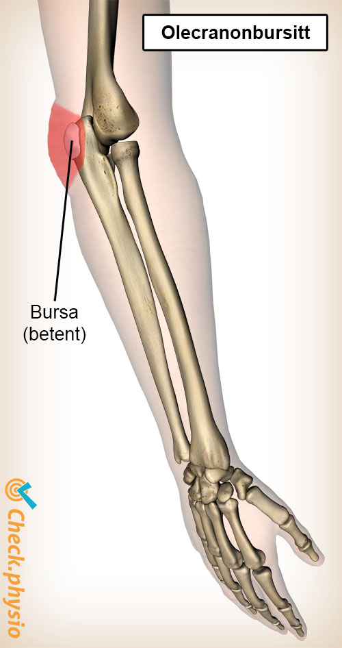 arm olecranonbursitt anatomi