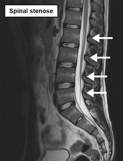 rygg lumbal ryggrad røntgen spinalkanal stenose innsnevring