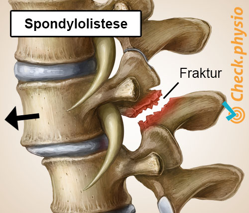 rygg spesifikke korsryggsmerter spondylolistese forskjøvet virvel