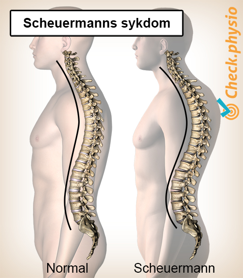 rygg Scheuermanns sykdom holdning ryggrad krumning kyfose
