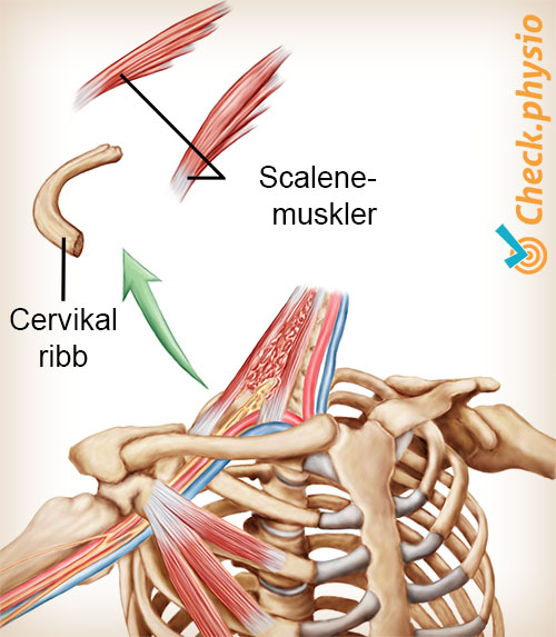 skulder arm hånd TOS thoracic outlet syndrom halsribben