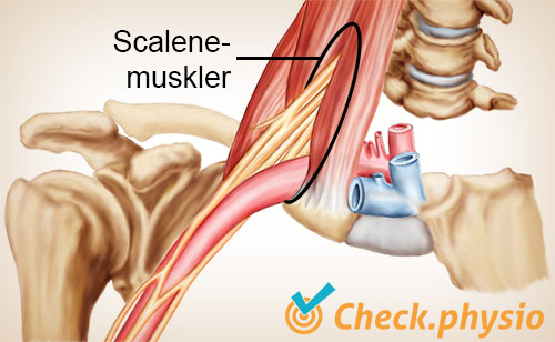 skulder arm hånd TOS thoracic outlet syndrom scalenusport