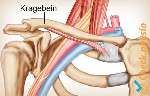 skulder arm hånd TOS thoracic outlet syndrom krageben