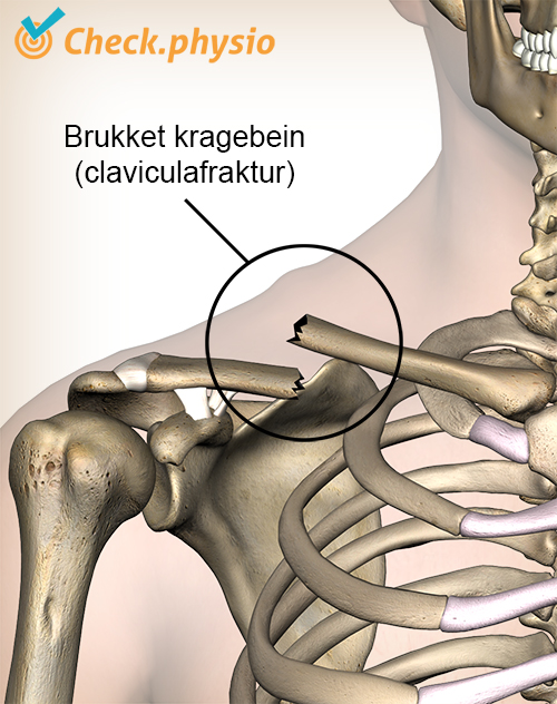skulder kragebein fraktur brukket kragebein brudd