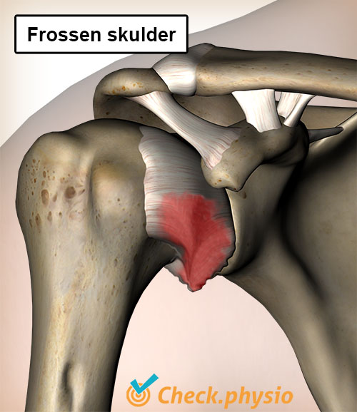 skulder frossen skulder