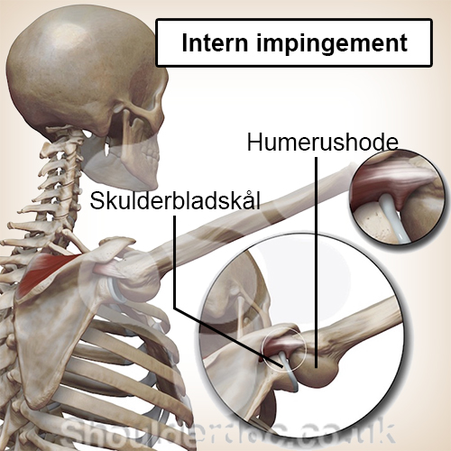 skulder intern impingement overarmsbein leddskål innklemming