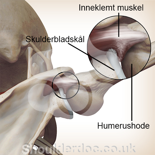 skulder intern impingement overarmsbein leddskål zoom innklemming