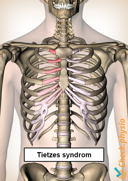 Tietzes syndrom ribbein smerte bryst brystbein