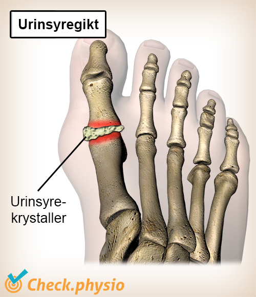 tå urinsyregikt urinsyrekrystaller