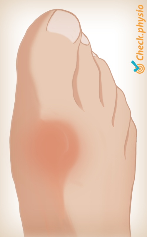 fot hallux rigidus bilde