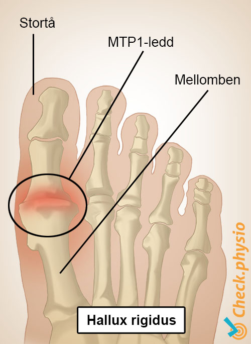 fot hallux rigidus stortå MTP1-ledd