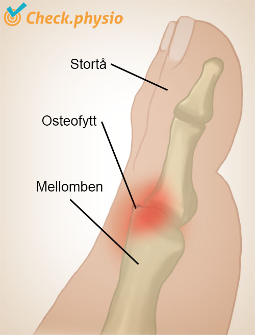 fot hallux rigidus osteofyttdannelse