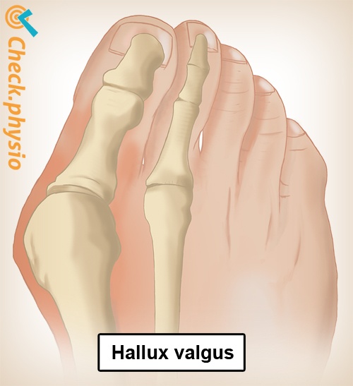 fot hallux valgus anatomi