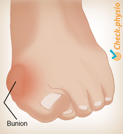 fot hallux valgus knyste