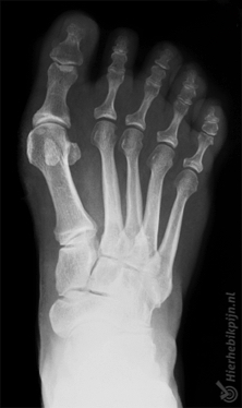 fot hallux valgus røntgenbilde