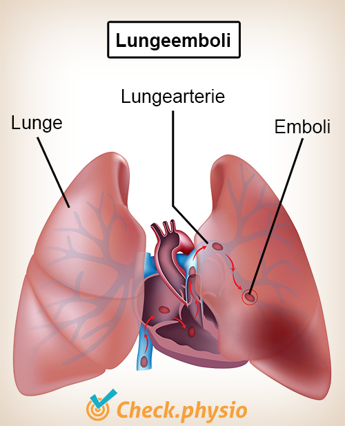bryst lunger lungeemboli hjerte lungearterie