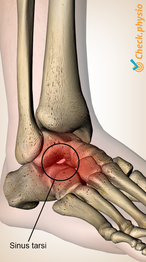 fot sinus tarsi syndrom talus calcaneus