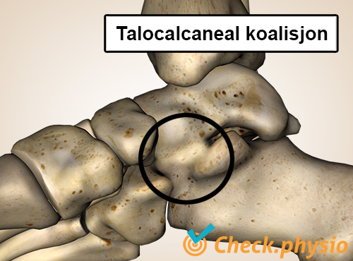 fot talocalcaneal koalisjon