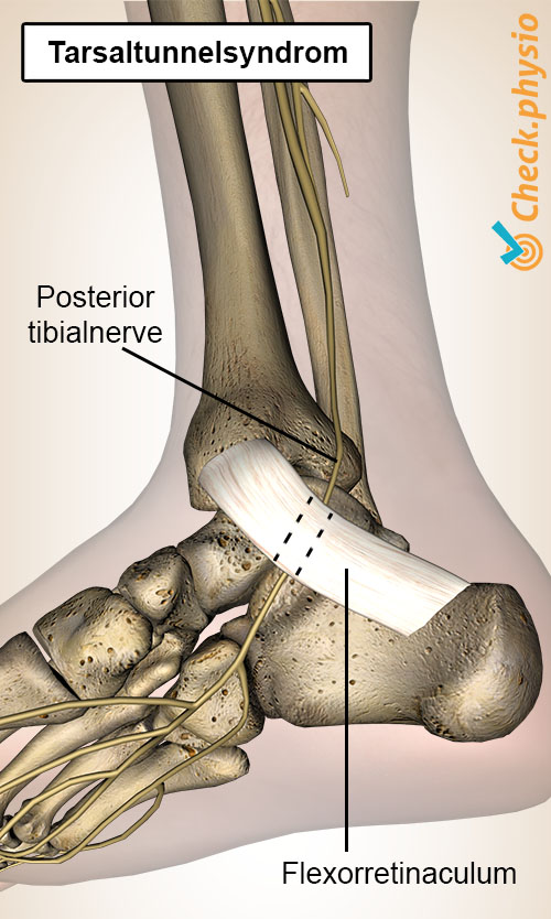 fot tarsaltunnelsyndrom nervus tibialis posterior retinaculum flexorum
