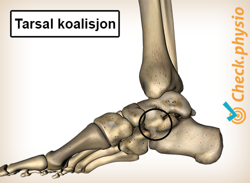 fot tarsal koalisjon medial innside