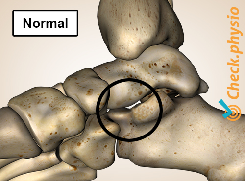 fot tarsal talokalkaneal koalisjon normal