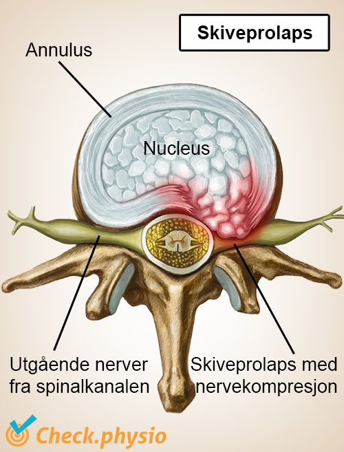 afbeelding_alt_wervelkolom-wervel-tussenwervelschijf-hernia-zenuwen