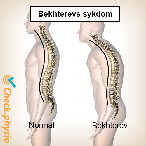Bekhterevs sykdom kyfose krum rygg
