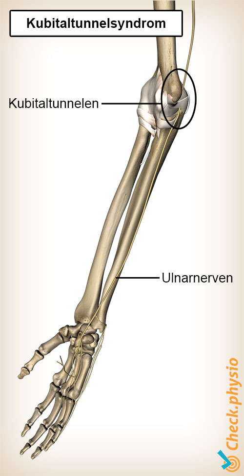 arm ulnar tunnel nervus ulnaris