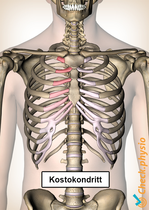 kostokondritt ribbein smerte bryst brystbein